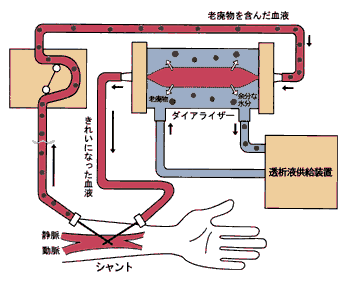 老廃物を含んだ血液　余分な水分　透析液供給装置　ダイアライザ―　老廃物　きれいになった血液　シャント　静脈　動脈